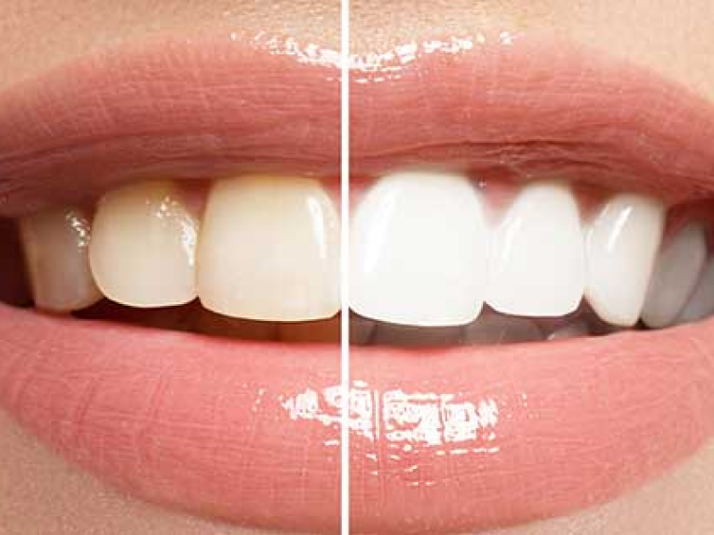 Blanqueamiento dental-2