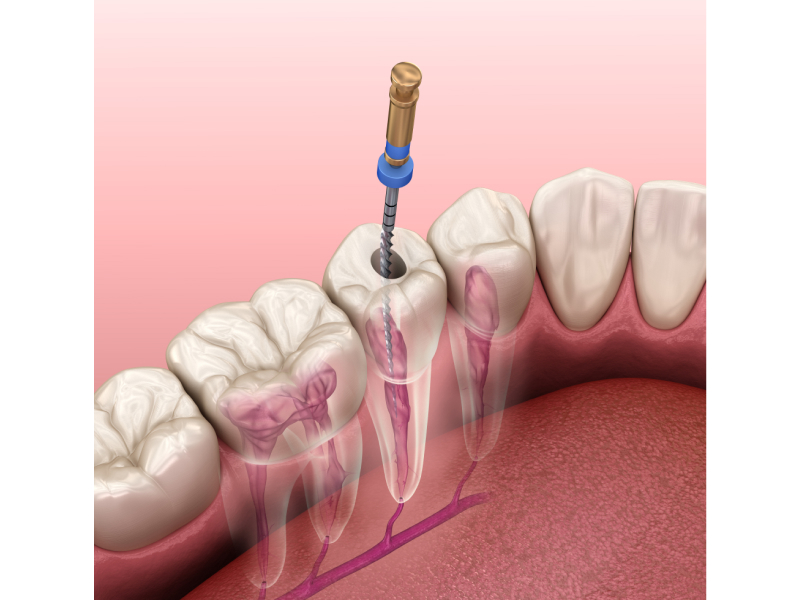 Endodoncia-1