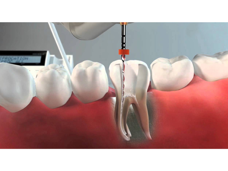 Endodoncia-2