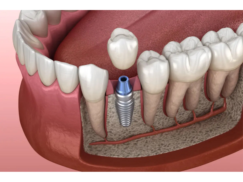 Implantes dentales-1