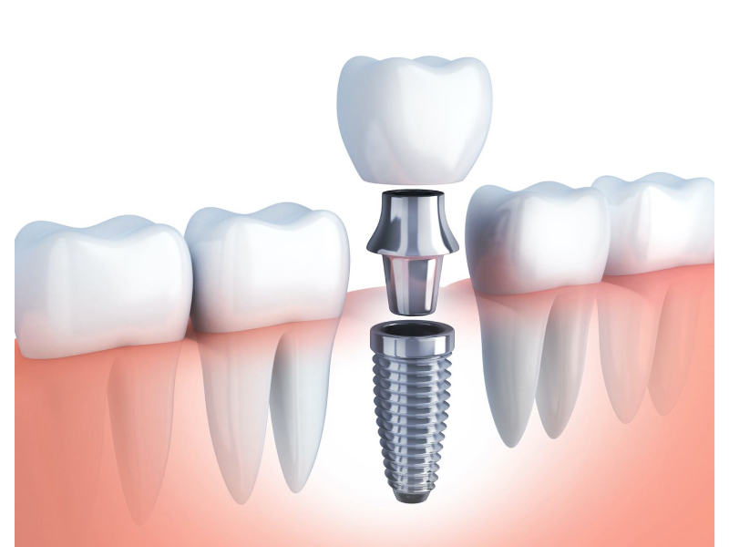 Implantes dentales-2