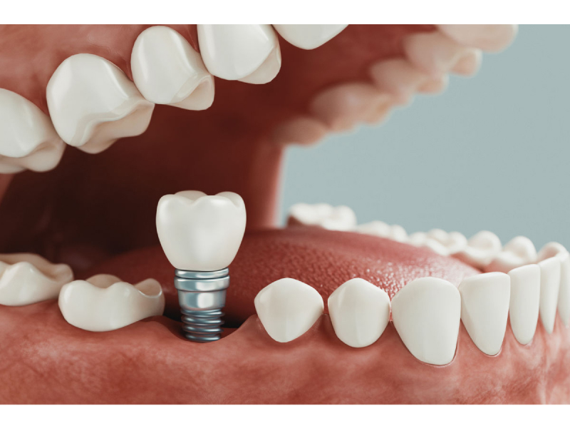 Implantes dentales-3