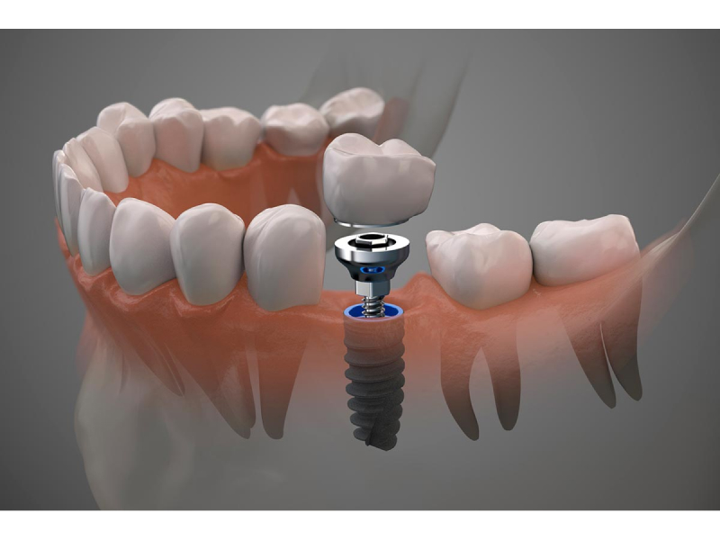 Implantes dentales-4