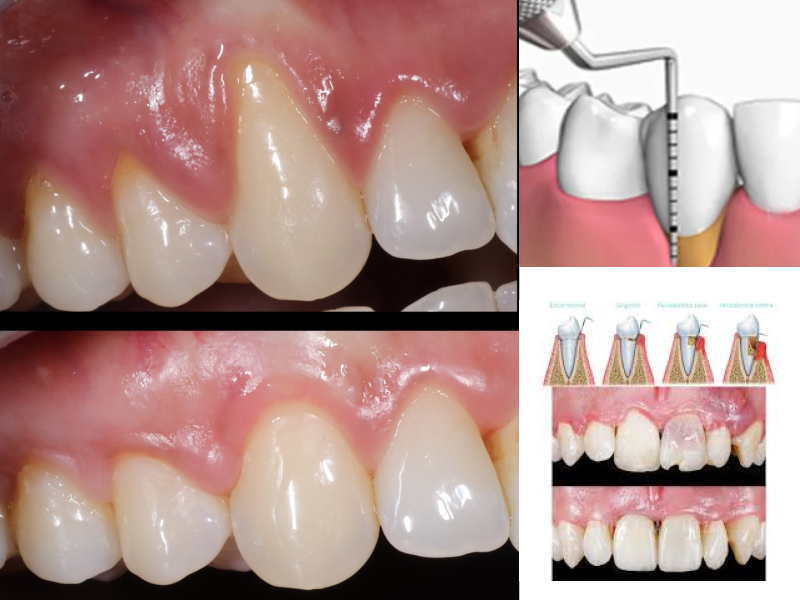 Periodoncia-1